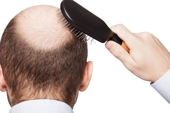 تجنب تساقط الشعر من خلال الحفاظ على الفيتامينات في جسمك