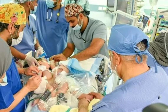 السعودية.. ردة فعل والد "التوأم السيامي" العراقي لحظة فصل ولديه (فيديو)